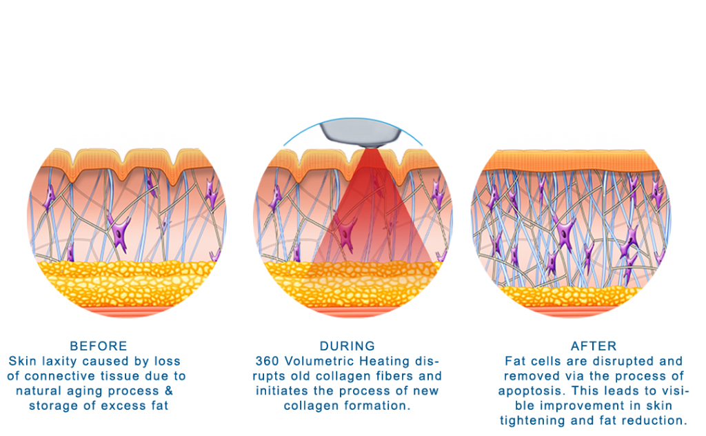 دستگاه BTL Aesthetics - Exilis Ultra 360